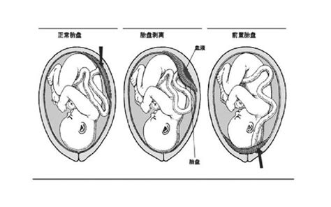 胎盤後壁 毛宮頂